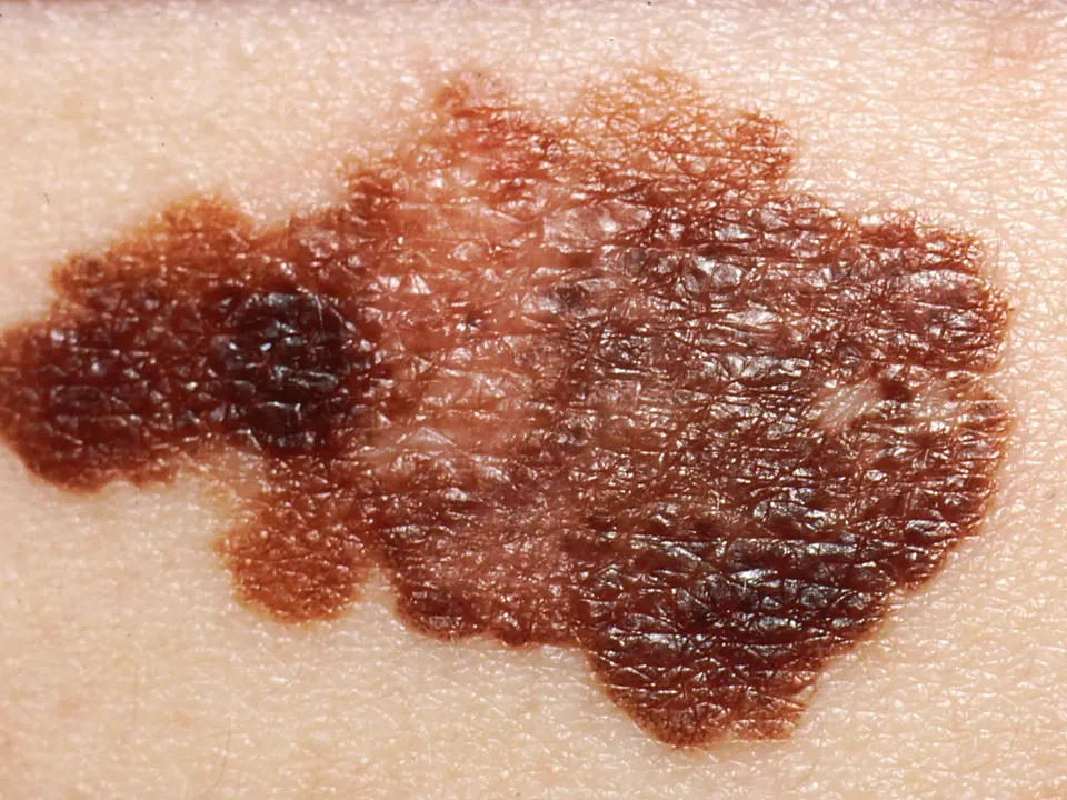 Una vacuna personalizada de ARNm reduce un 42 % el riesgo de que el melanoma reaparezca o cause la muerte