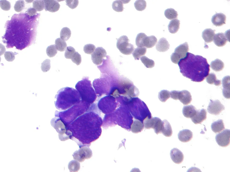 Dos fármacos combinados reducen un 58 % el riesgo de muerte en el cáncer de pulmón más agresivo, según un ensayo presentado en Madrid